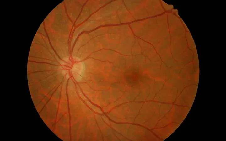 Esame del fondo oculare (fundus oculi)