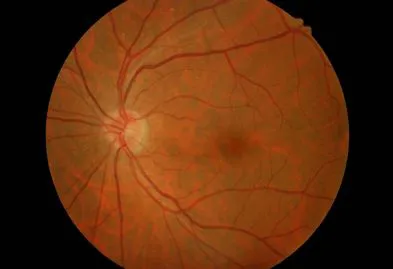 Esame del fondo oculare (fundus oculi)
