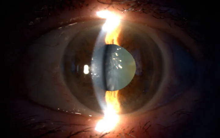 Foto del fundus (retinografia) e del segmento anteriore