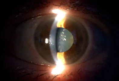 Foto del fundus (retinografia) e del segmento anteriore 