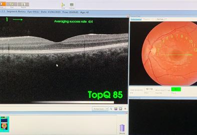 Esame OCT della retina e del nervo ottico