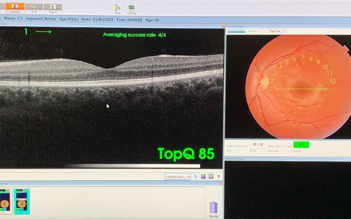Esame OCT della retina e del nervo ottico