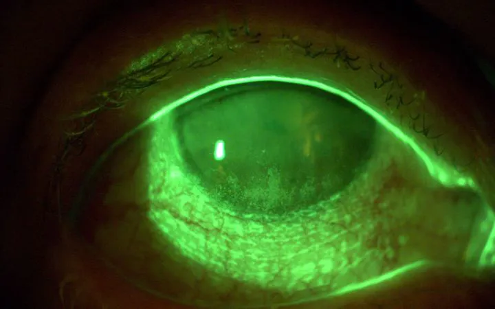 Studio del film lacrimale con diagnosi e cura dei disturbi correlati