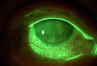 Studio del film lacrimale con diagnosi e cura dei disturbi  correlati